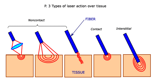 Types of laser instruments and corresponding laser action